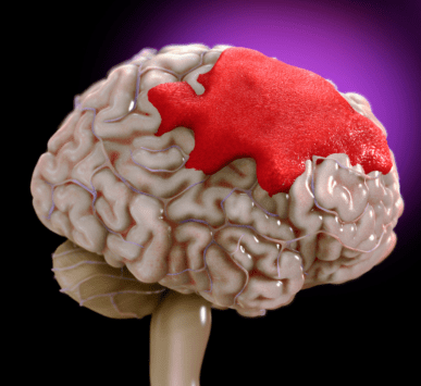 Brain Hemorrhage