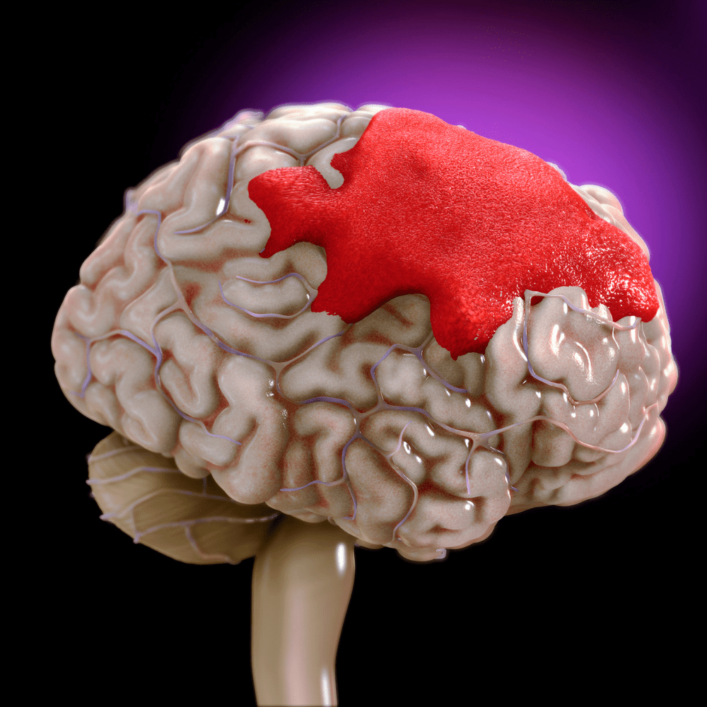 Brain Hemorrhage